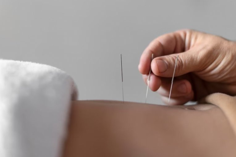 دورة الوخز بالإبر الصينية للأغراض التجميلية
